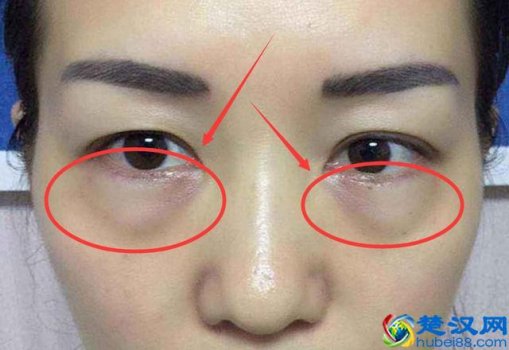  眼袋怎么去小窍门？一招让你年轻五岁