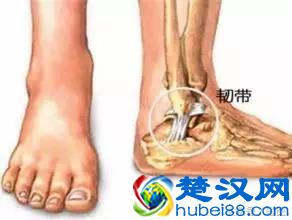  脚踝扭伤怎么处理？骨科医生说这才是正确的处理方法
