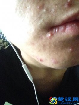  嘴边长痘痘是什么原因（长痘痘后的注意事项）