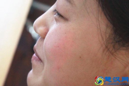  毛孔粗大如何改善（毛孔粗大的原因是什么？）