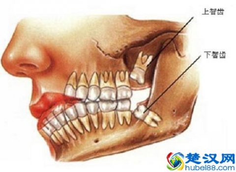  智齿疼怎么办，教你小窍门止疼！