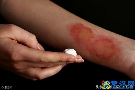  开水烫伤怎么办，一定要懂的紧急处理方法！