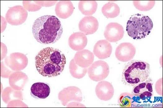  尿白细胞偏高的原因有哪些，需要注意哪些方面！