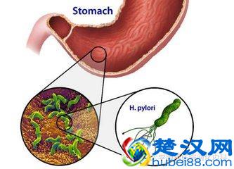  幽门螺杆菌吃什么药，幽门螺杆菌是什么症状！