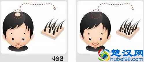  植发的危害有哪些，什么是植发！