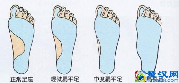  什么是平足和弓足？有什么影响