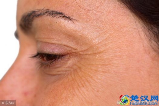  有鱼尾纹怎么办？一个月彻底消除