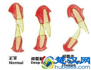  龅牙怎么办？孩子龅牙的原因你知道么，从根源解决龅牙问题