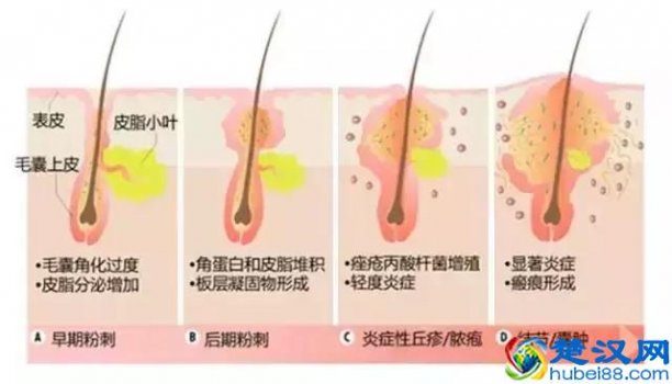  鼻子有痘坑怎么办（鼻子凹坑最难治）