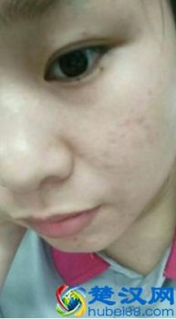  怎么去青春痘最快最有效的方法是什么（挤出世界上最大的痘痘）