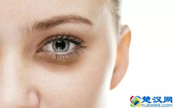  黑眼圈啥原因引起的（黑眼圈类型图解）