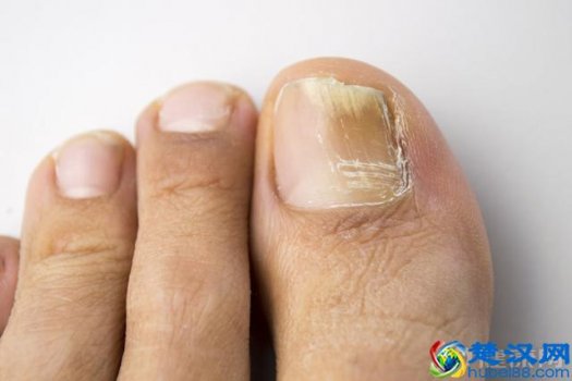  灰指甲怎么办（得了灰指甲怎么治）