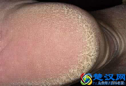  脚后跟干裂起硬皮怎么办（脚后跟干裂，有角质化硬皮怎么办）