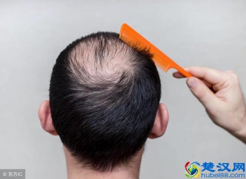  爱掉头发怎么办？调整饮食是预防掉发的最好方法