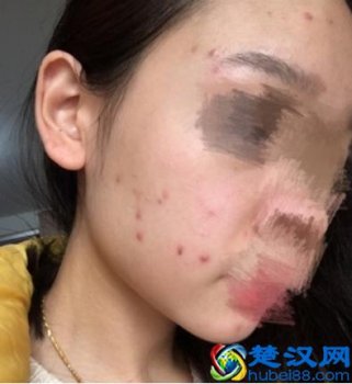  怎么样去痘痘不留痕迹（痘痘里面挤出来的白色东西是什么）