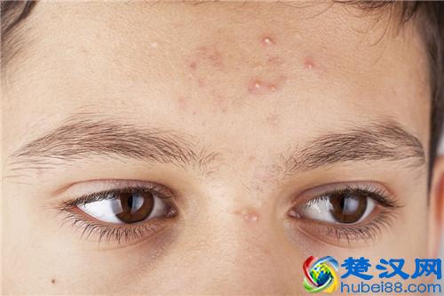  粉刺是什么东西如何引起的（去粉刺最有效的3个方法）