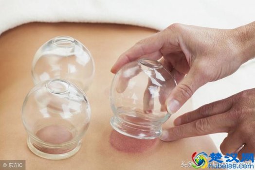  拔罐的好处和坏处你知道吗？拨火罐并不适合每一个人