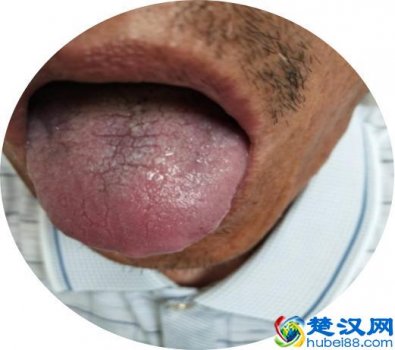  肝硬化吃什么药得快（史上最全治疗肝硬化方案）