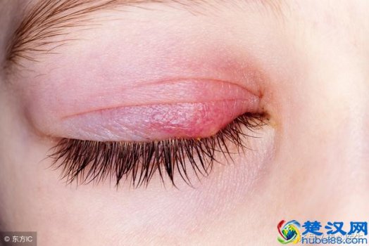  反复起针眼是什么原因引起的（关于麦粒肿必须知道的3点）
