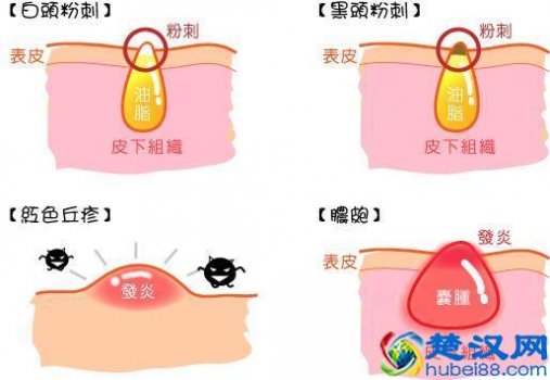  痘痘反复长是什么原因（长痘痘吃什么最好）