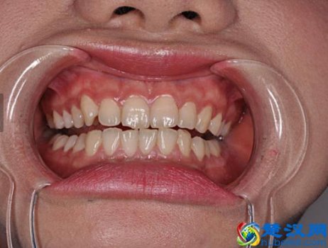  牙疼怎么办？民间土方教你一招止疼