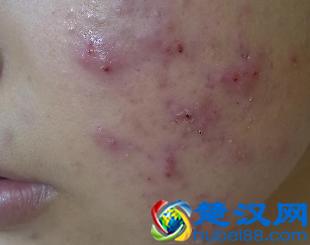  痤疮怎么治疗最好（皮肤科医生告诉你解决方案）