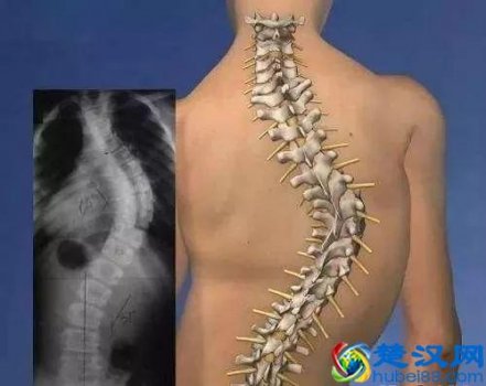  儿童穿背背佳有效果吗（儿童高低肩用什么纠正）