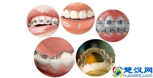  矫正牙齿要多少钱（14岁带牙套1-12月变化）