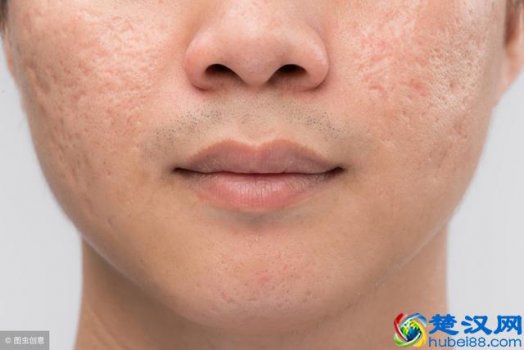  减少油性皮肤毛孔粗大的方法（毛孔粗大是缺少胶原蛋白）