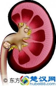  肾结石怎么治最好，每天这么吃就能轻松排石头！