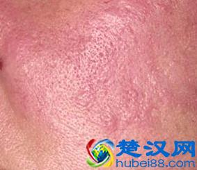  红斑狼疮早期症状有哪些，怎么治疗红斑狼疮