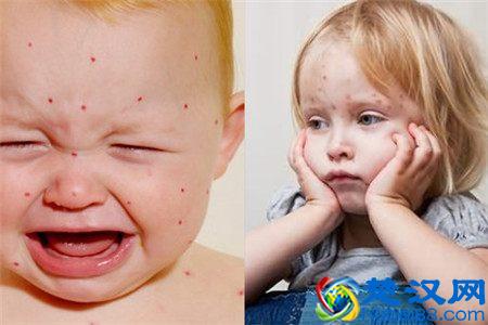  水痘的症状和治疗方案有哪些！