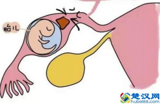  宫外孕早期症状是什么吗，需要注意哪些地方！