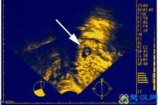  宫外孕症状有哪些，宫外孕该怎么办！