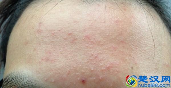  脸上长粉刺怎么办（教你怎么预防粉刺反复出现）