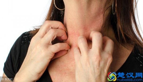  什么是湿疹（湿疹有哪些症状）