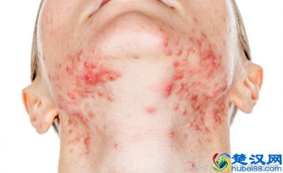 痤疮是什么样的症状(痤疮形成的原因)