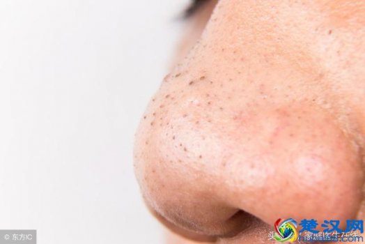  女生鼻子上的黑头怎么去掉（学会三招还你洁白面孔）