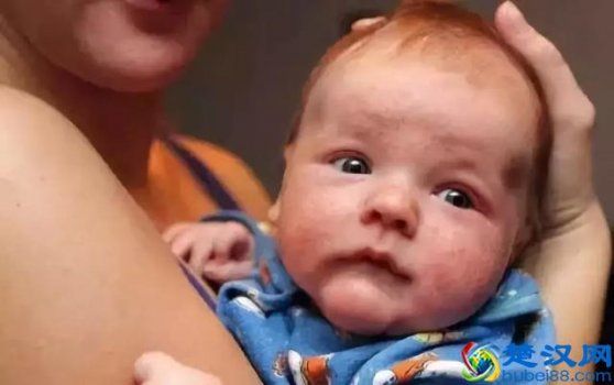  孩子满脸青春痘怎么办（十四五青春痘怎么处理）