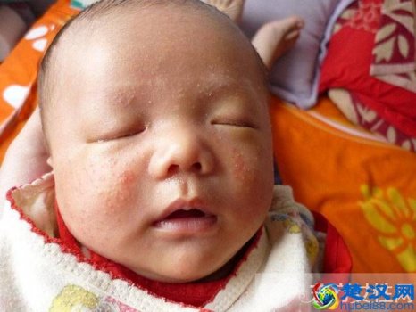  什么是婴儿湿疹，婴儿湿疹该怎么办！