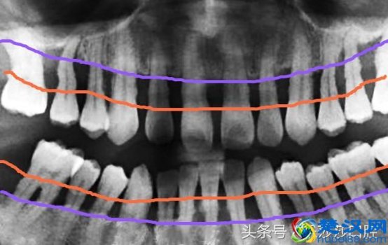  牙周炎能治好吗（得了牙周炎怎么办）