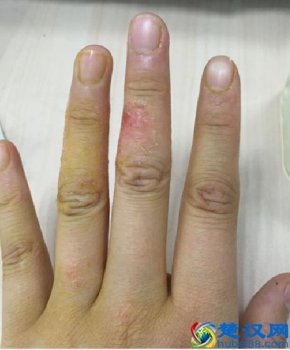  湿疹怎么引起的（环境因素最重要）