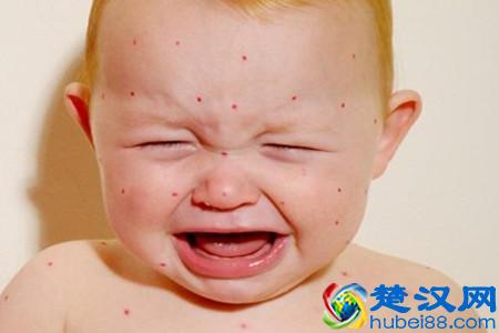  新生儿湿疹怎么办，新生儿湿疹什么原因！