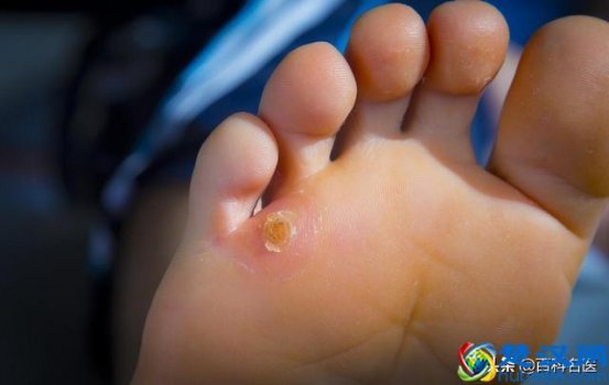 为什么会长鸡眼在脚上(鸡眼是怎么造成的)