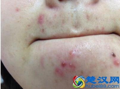  下巴上长痘痘是什么原因引起的（快速祛痘好办法推荐）