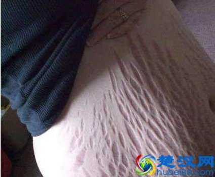  去妊娠纹最好的办法有哪些！