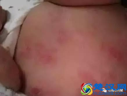  婴儿湿疹的最佳治疗方案！