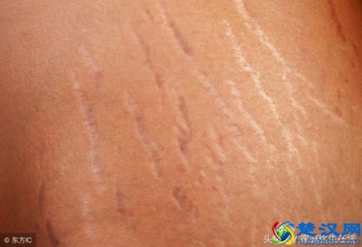  妊娠纹去除价格是多少，真的有效吗！