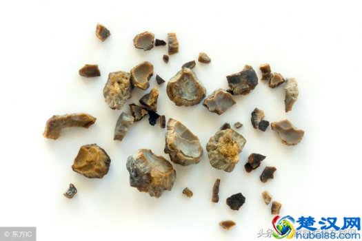  肾结石形成的三个原因？趁早预防