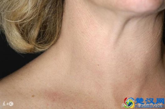  甲状腺炎怎么治疗？做好预防才是关键